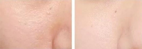 毛孔粗太抢眼？这款超好用的洁面泡泡给你一个脸部SPA